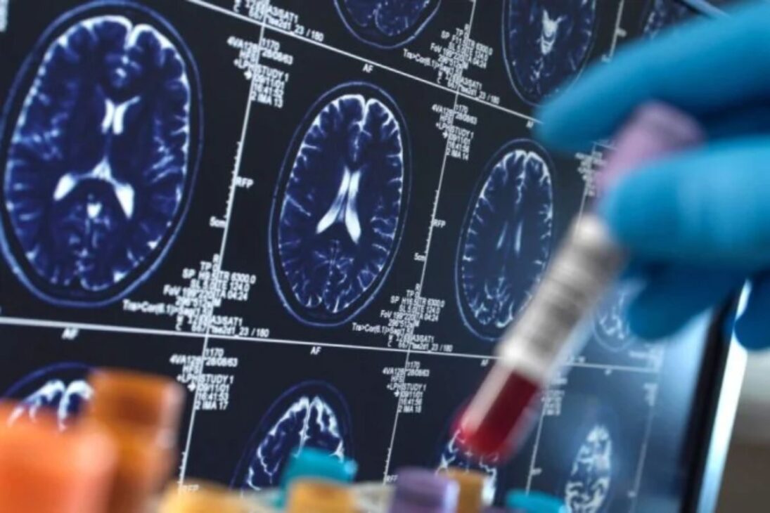 Universidade de Cambridge cria IA que prevê risco de Alzheimer com alta precisão e ajuda a identificar tratamentos eficazes