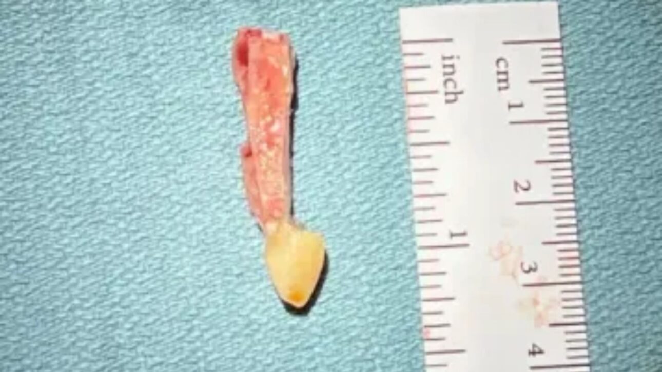 Homem volta a enxergar após 20 anos de cegueira com rara cirurgia que usa um dente para sustentar lente no olho. Técnica inédita no Canadá.