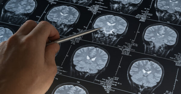 Mão humana segurando uma caneta aponta para imagem de ressonância magnética do cérebro, destacando análise de possíveis alterações neurológicas associadas a traumas e vírus adormecidos.