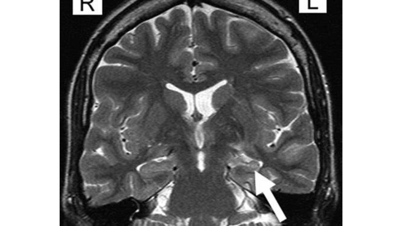 Neurologistas explicam como o déjà vu surge no cérebro e quando episódios frequentes podem indicar epilepsia ou estresse.