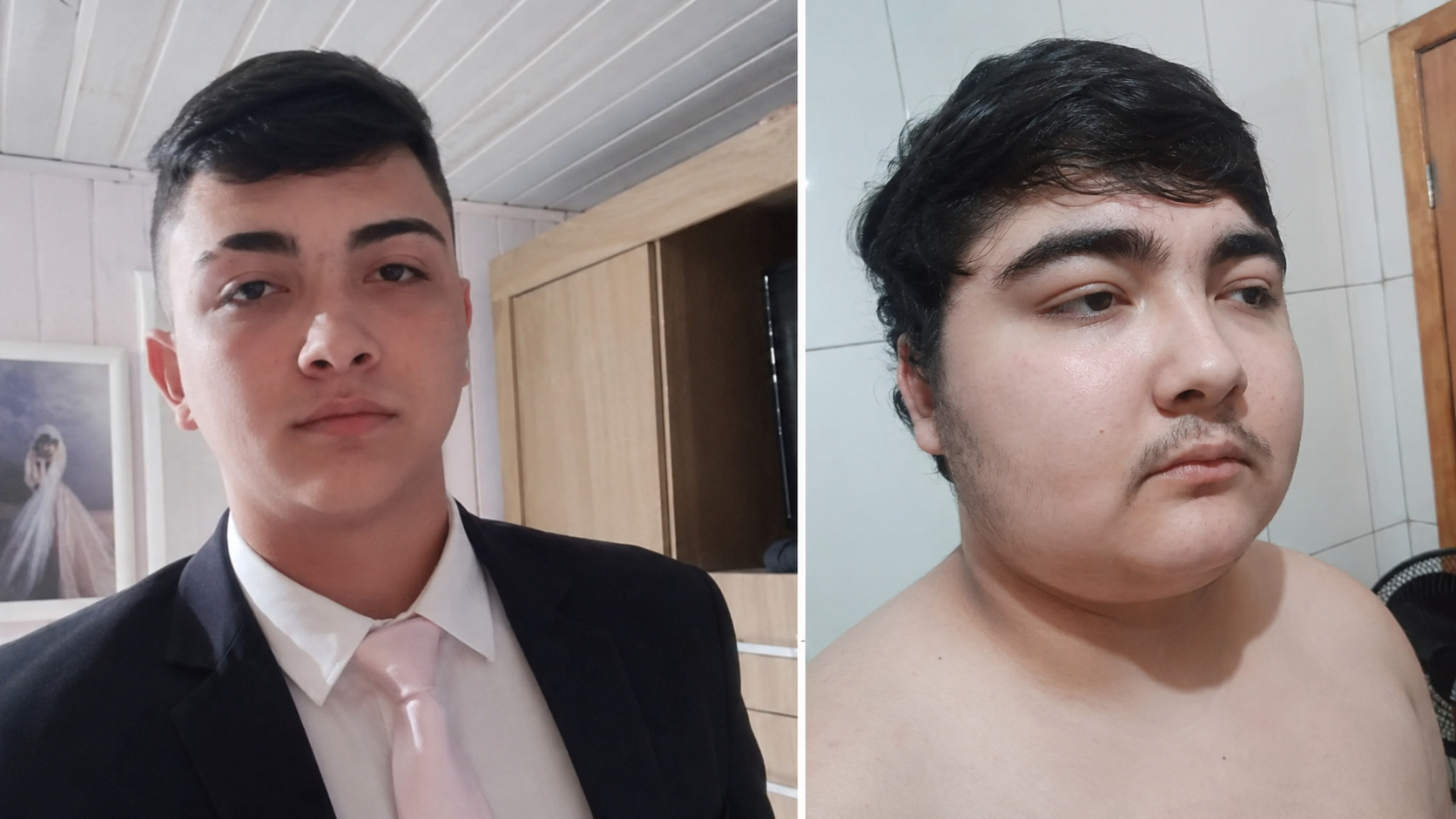 Comparação ilustrativa de adolescente antes e depois do ganho de peso causado por tumor na hipófise e doença de Cushing.