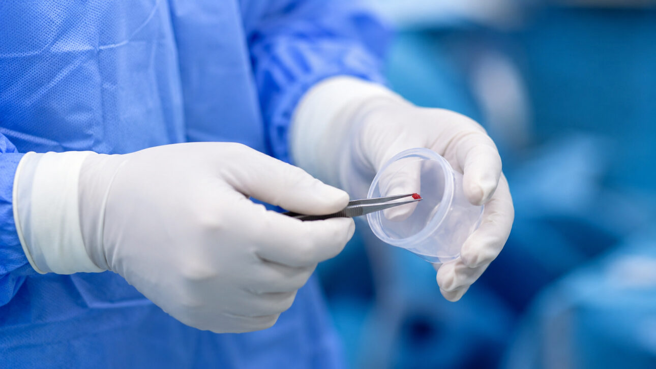 Doctor with gloves holds a sample of pituitary tumor with tweezers after surgery to treat Cushing's disease.
