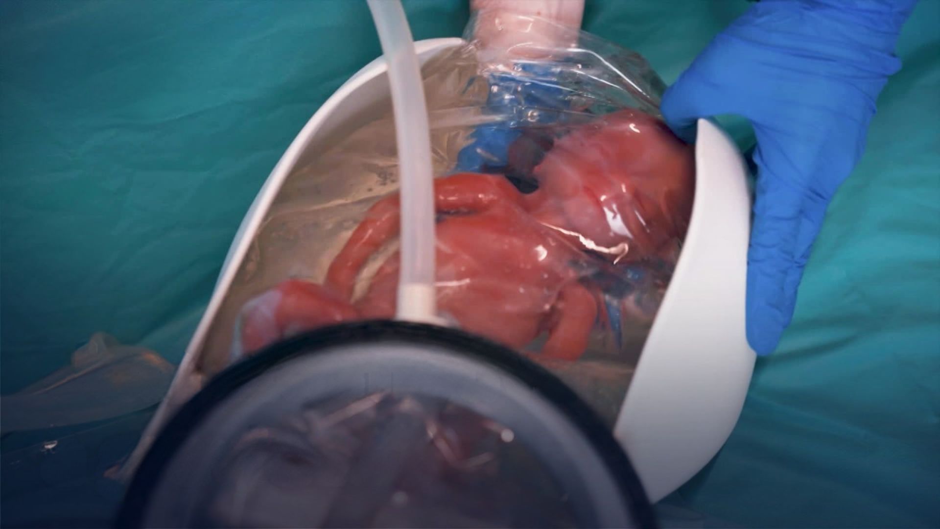 Pesquisadores de Eindhoven desenvolvem o AquaWomb, útero artificial para prematuros extremos. Testes clínicos em 5 a 6 anos. E surge a pergunta: quem vai controlar a reprodução?